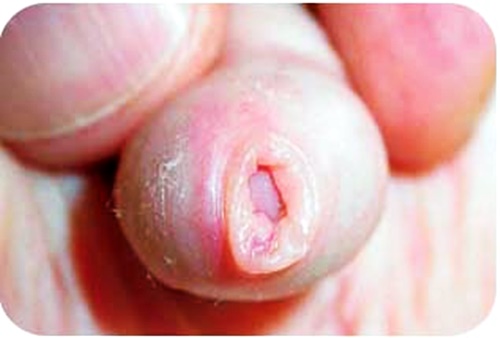 Fimose Causas – Saiba Tudo, O Que É, Tratamento e Dicas